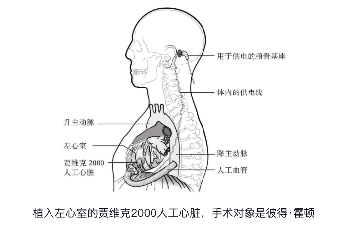 贾维克 2000 安装示意图